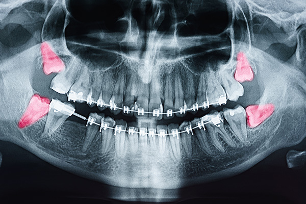 Northern Star Oral and Maxillofacial Surgery LLC | Oral Surgery, Wisdom Teeth and General Anesthesia